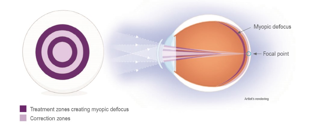 optics of MiSight MiSight info